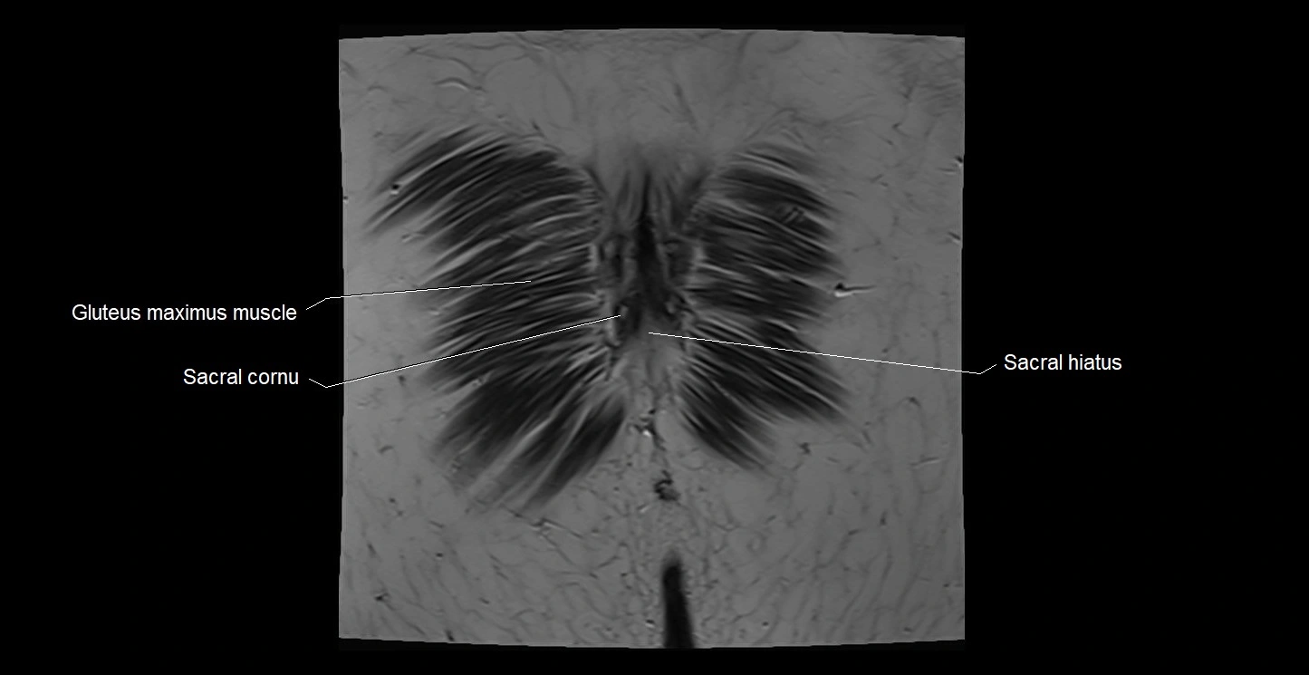 MRI coronal cross sectional anatomy male pelvis image 43.webp
